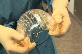 Neurocirurgiões implantam com sucesso um crânio feito em impressora 3D