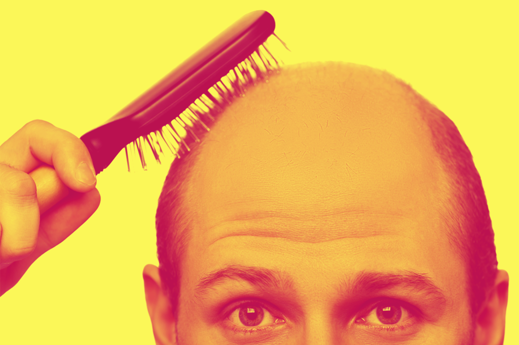 Descoberta de causa da calvície pode levar a novo tratamento
