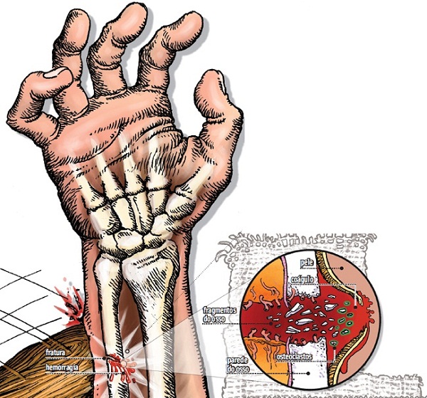 Como um osso quebrado se regenera?