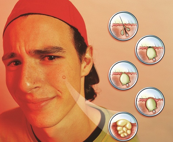 Como nascem os cravos e as espinhas?