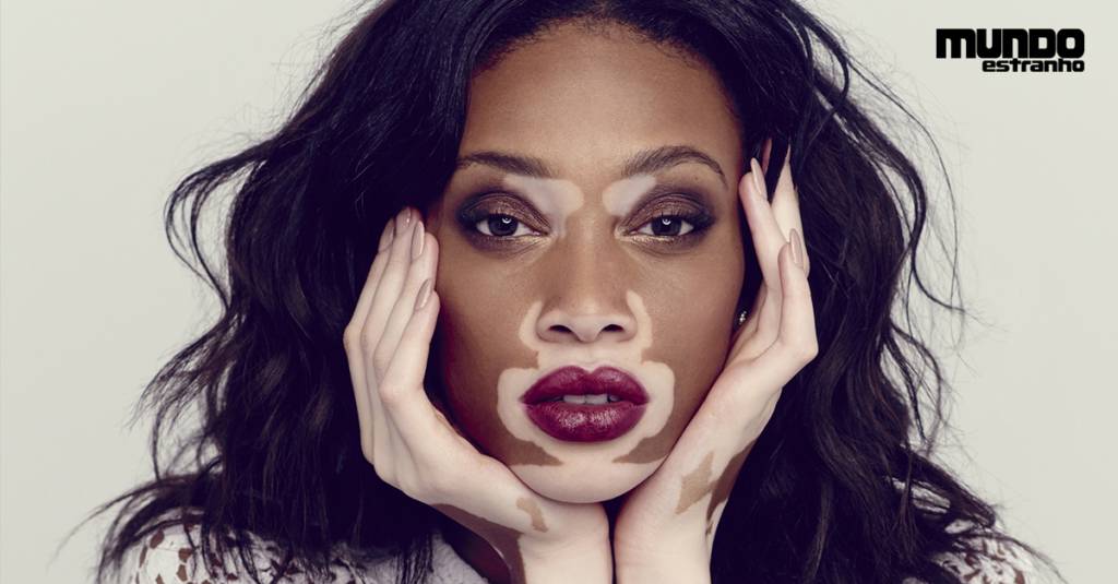 O que é vitiligo?