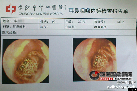 Chinesa fica 5 dias com aranha viva instalada no canal auditivo
