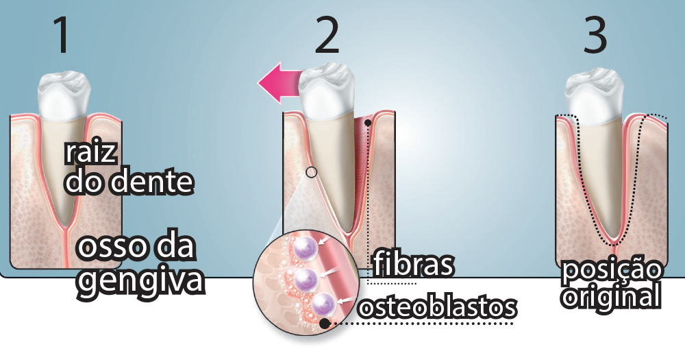 Como os aparelhos corrigem os dentes das pessoas?