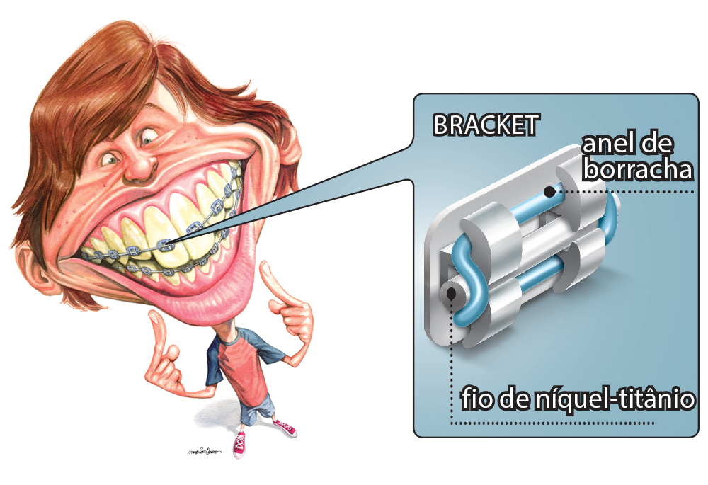 Como os aparelhos corrigem os dentes das pessoas?