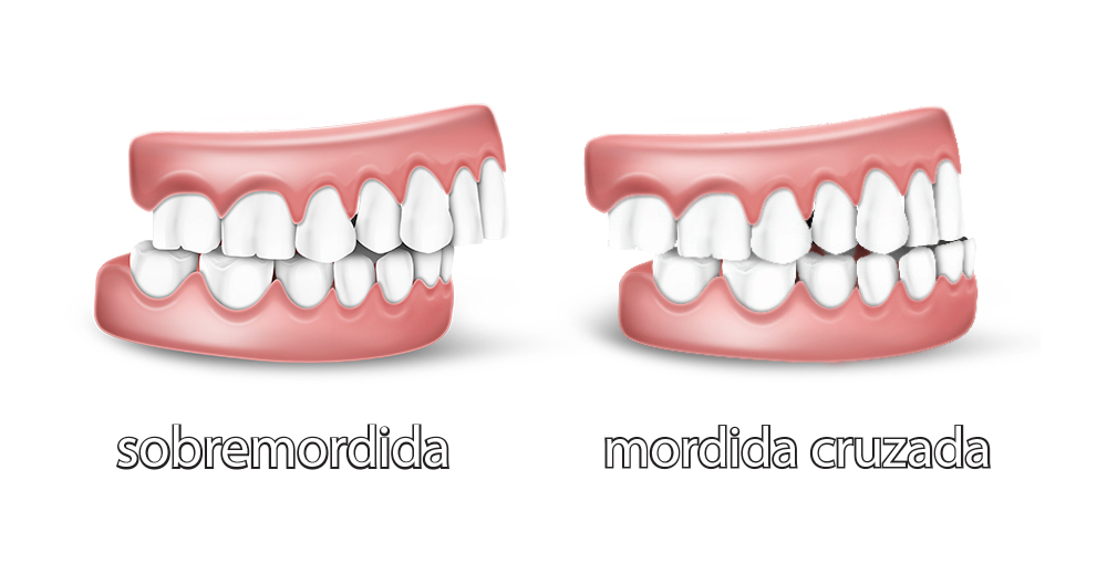 Como os aparelhos corrigem os dentes das pessoas?