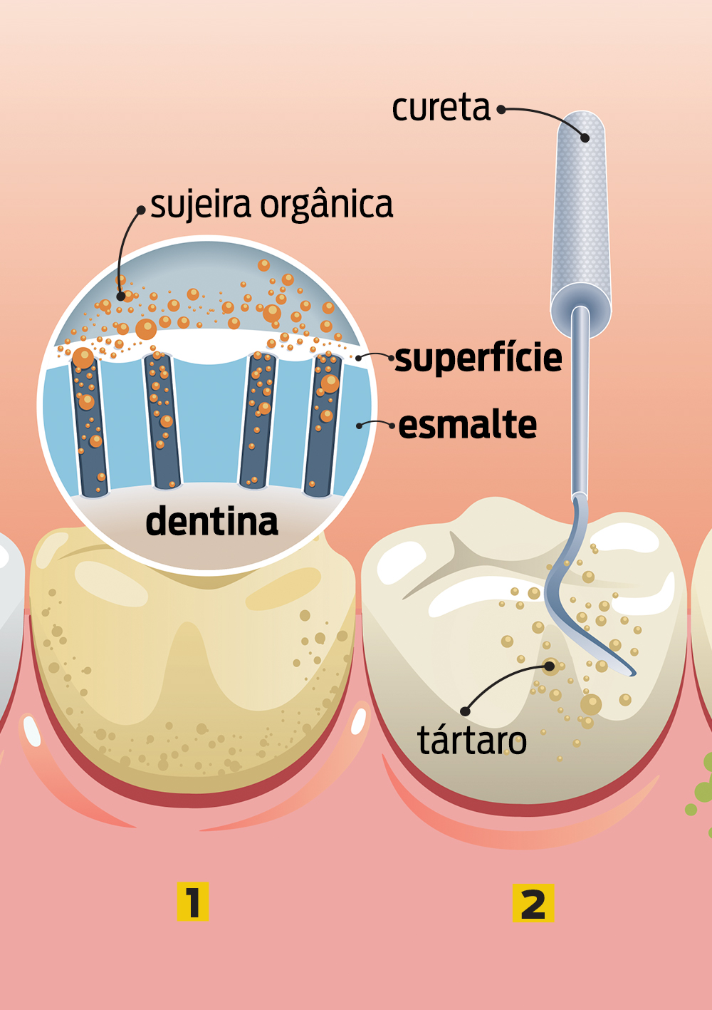 Como é feito o clareamento dental?