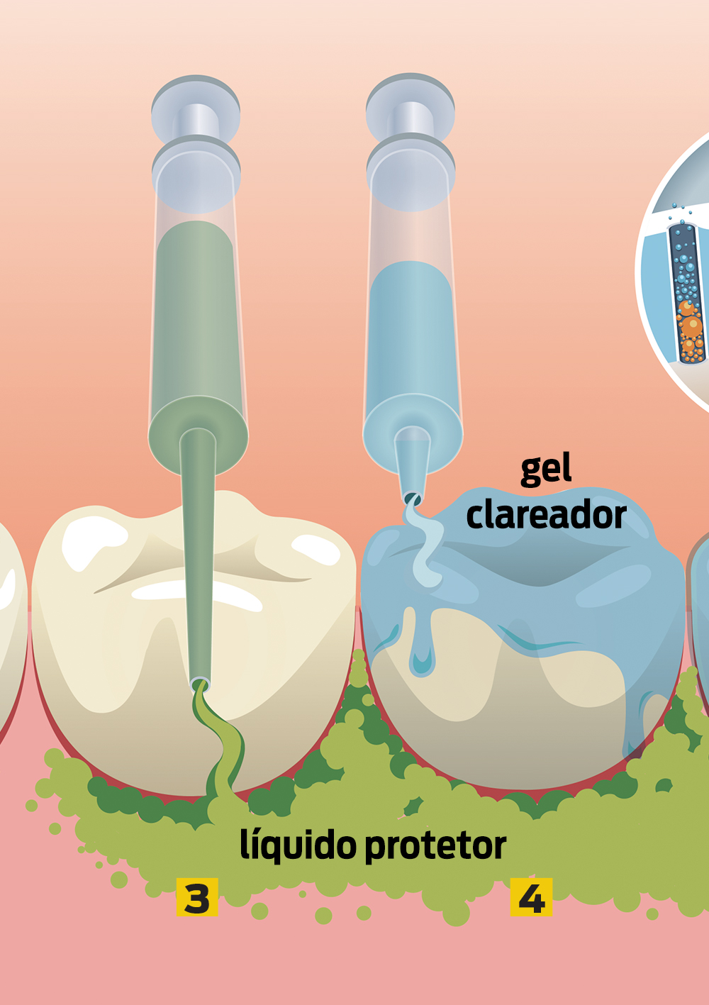 Como é feito o clareamento dental?