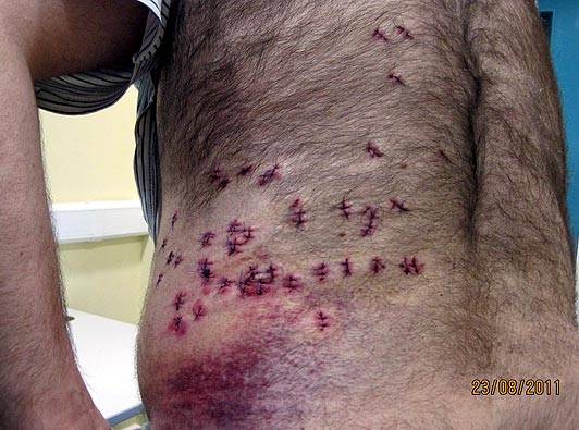 Homem sobrevive a 38 facadas porque estava acima do peso