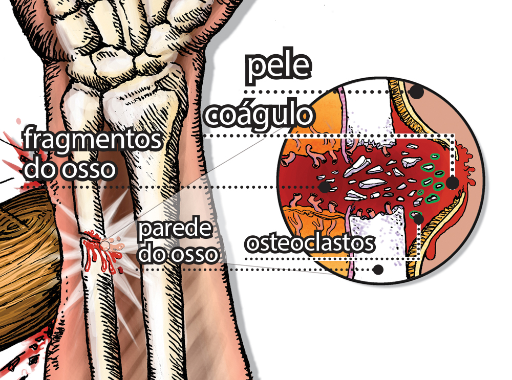 Como um osso quebrado se regenera?