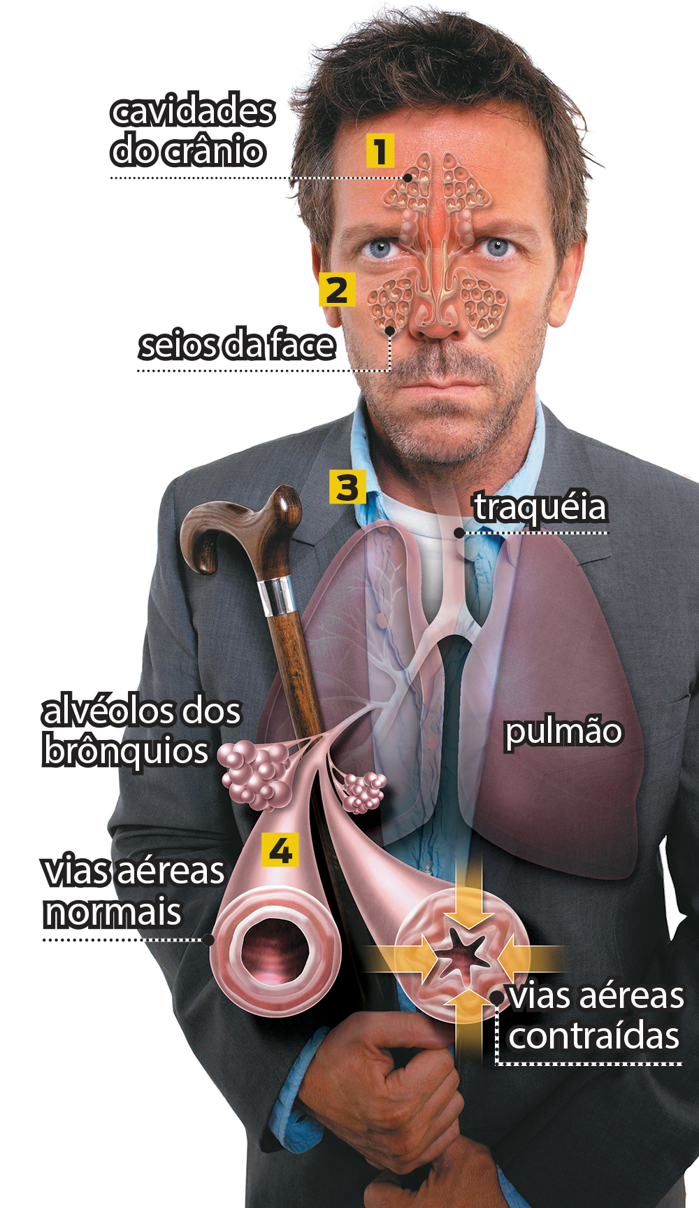 Qual é a diferença entre asma, rinite, bronquite e sinusite?