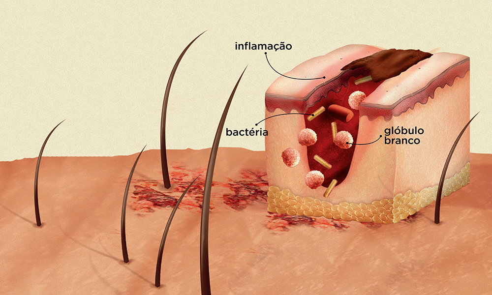 inflamação