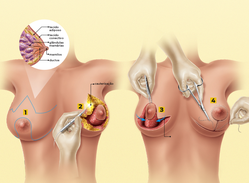 Como se faz uma cirurgia  de redução da mama?