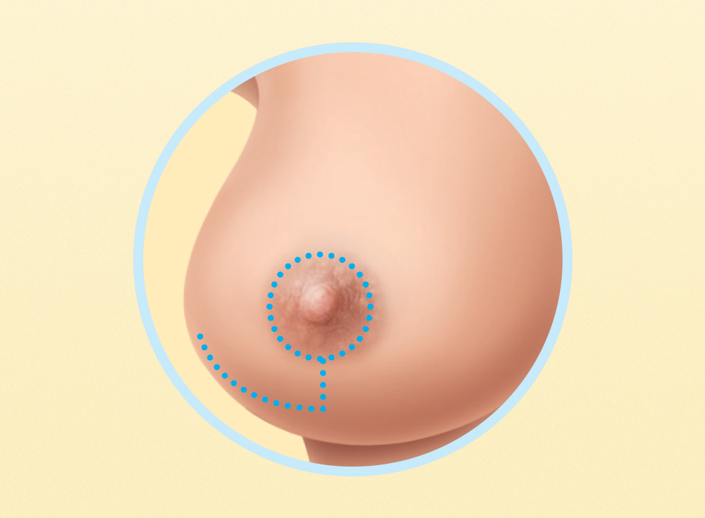 Como se faz uma cirurgia  de redução da mama?