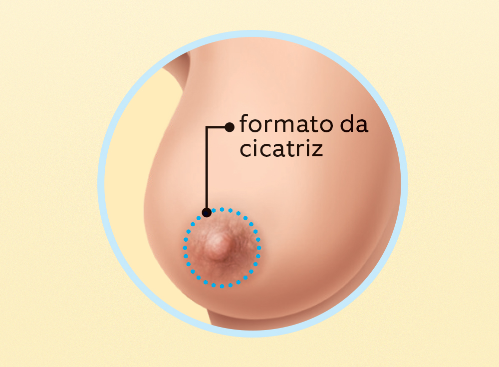 Como se faz uma cirurgia  de redução da mama?