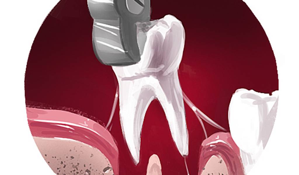 Como é uma cirurgia de extração do siso?