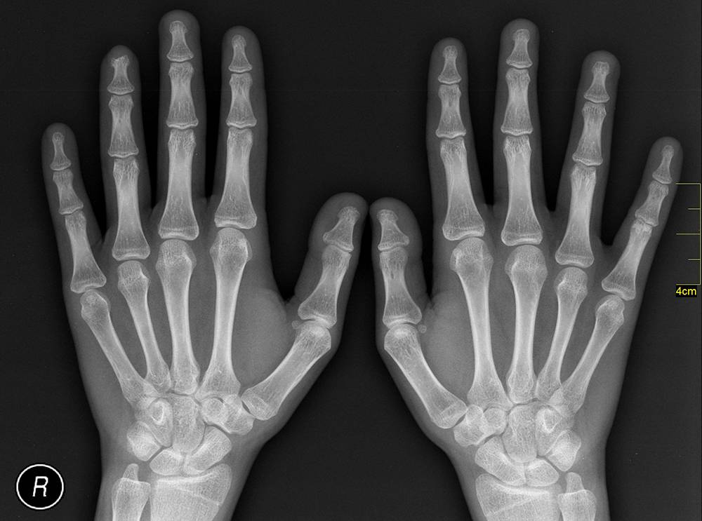Qual é a diferença entre raios X e escaneamento de corpo?