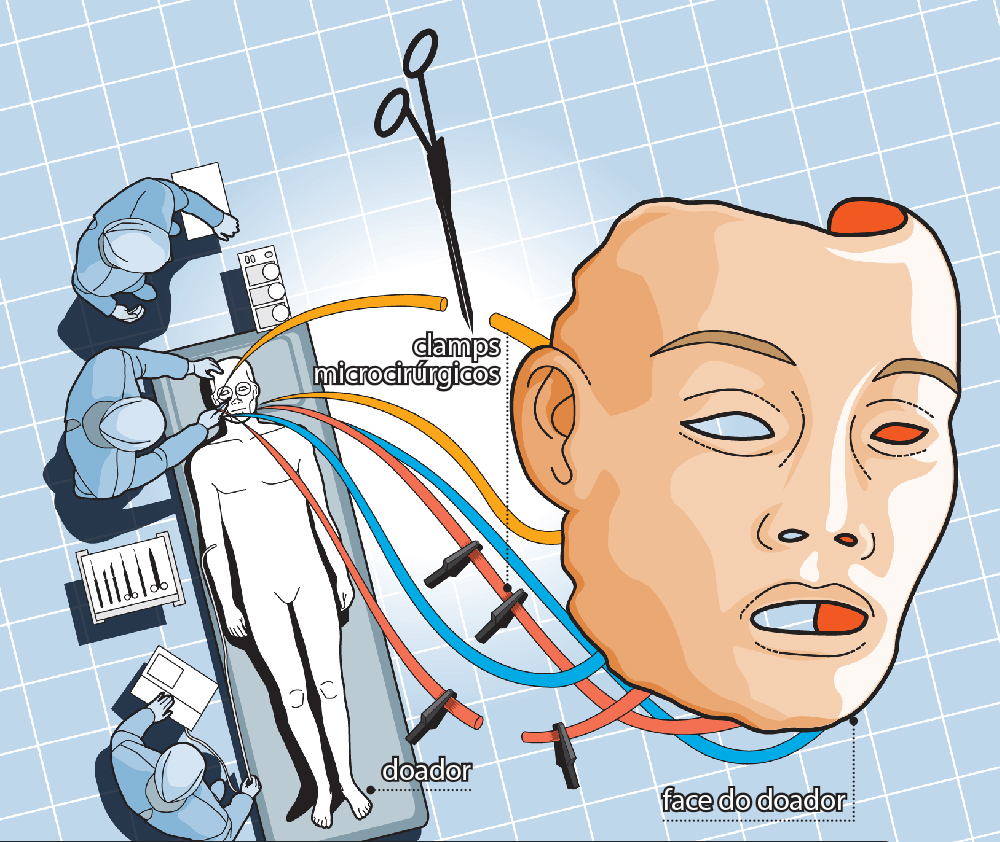 Como é feito um transplante facial?