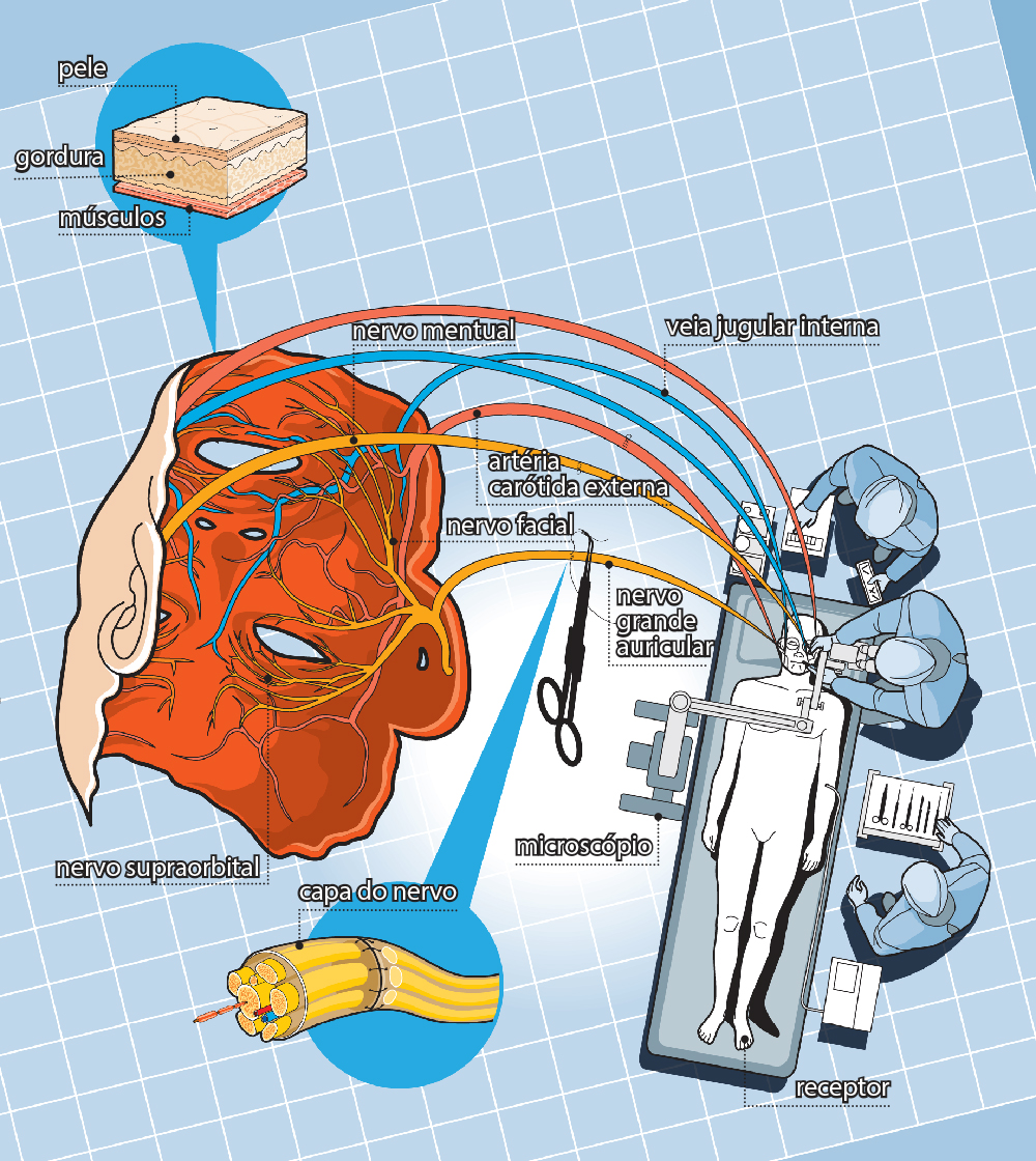 Como é feito um transplante facial?