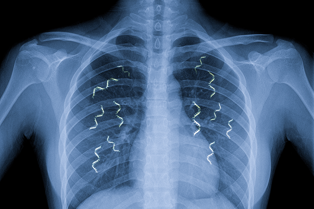 Inalação com moléculas de RNA pode ensinar pulmão a fazer os próprios remédios