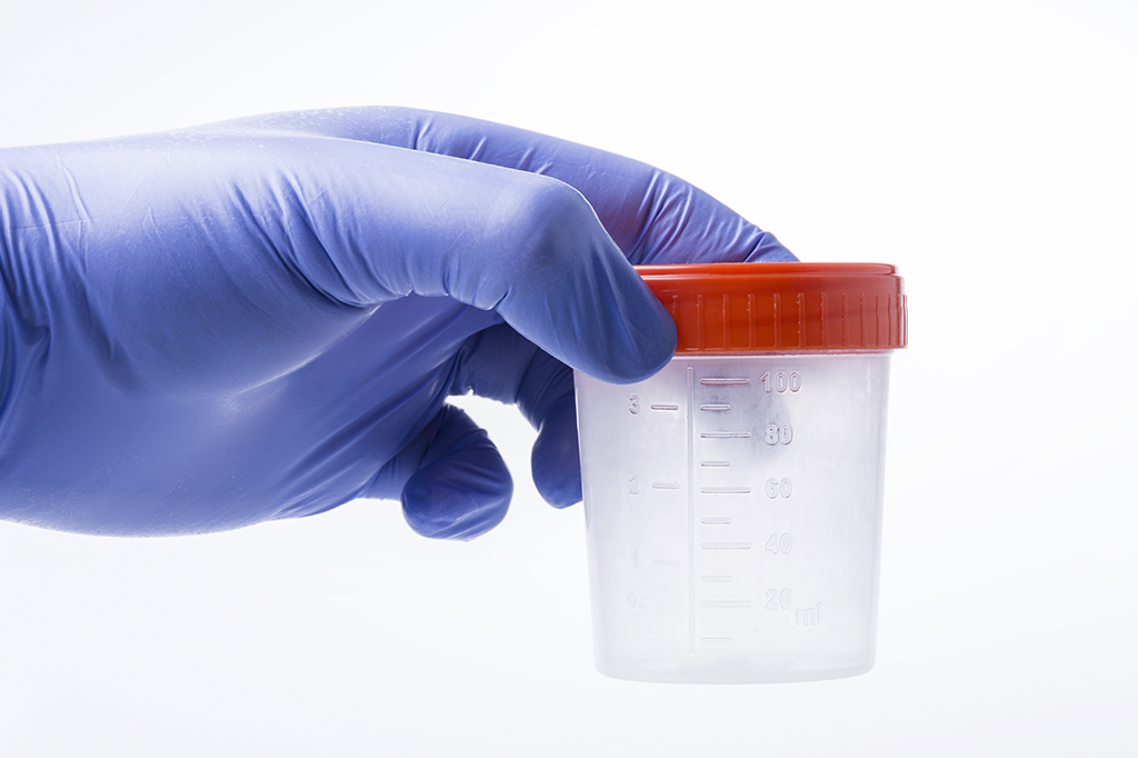 Exames de urina podem substituir papanicolau no futuro