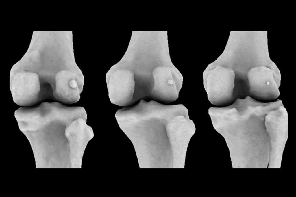 O osso da artrose está voltando com força total