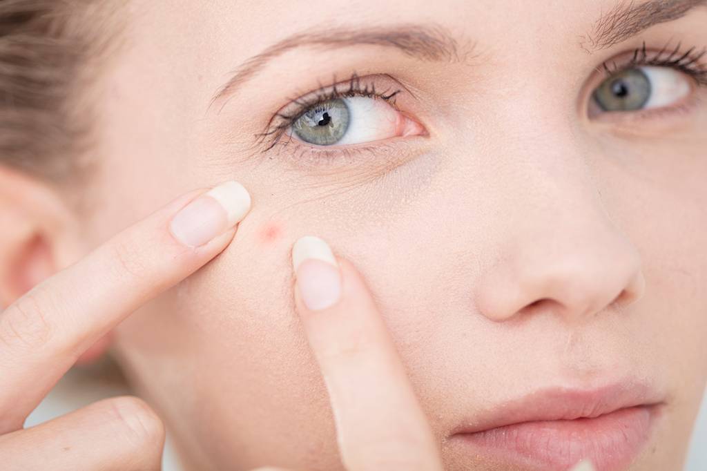 Existem diferenças entre a acne adolescente e a acne adulta – saiba quais