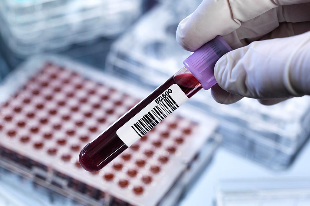 Exame de sangue pode detectar câncer anos antes dos primeiros sintomas