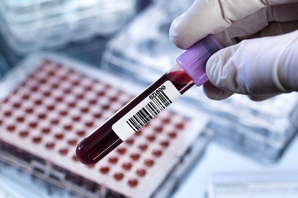 Exame de sangue pode detectar câncer anos antes dos primeiros sintomas