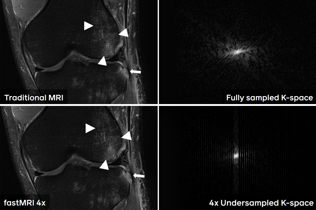 Intelig&ecirc;ncia artificial pode tornar resson&acirc;ncias magn&eacute;ticas quatro vezes mais r&aacute;pidas