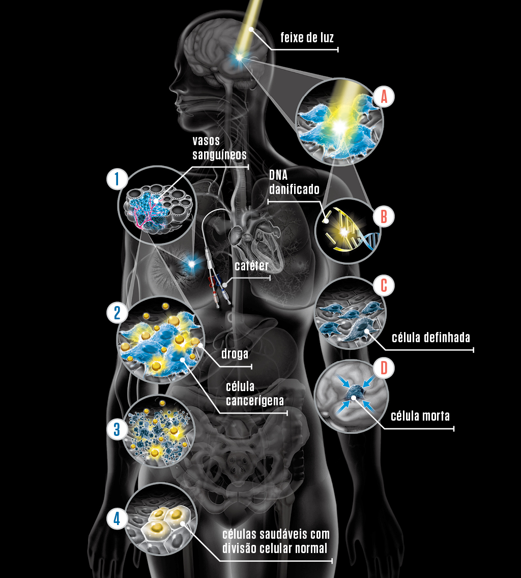 Infográfico sobre a radioterapia e quimioterapia.