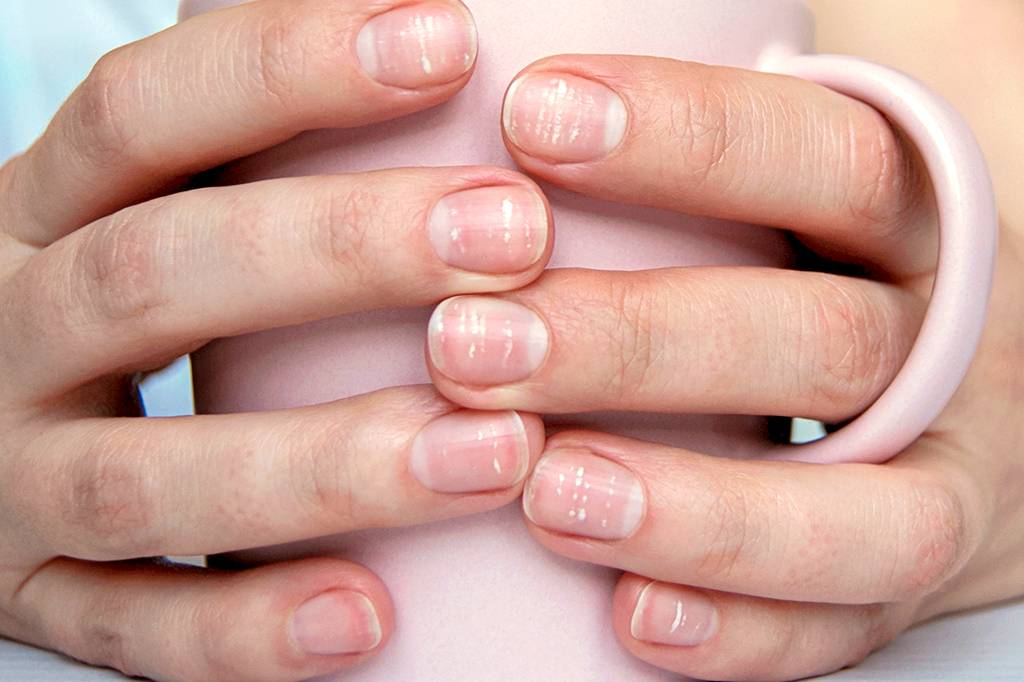 O que as marcas nas suas unhas dizem sobre sua saúde?