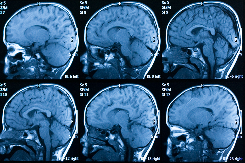 Pessoas com depressão podem ter certa rede neural maior que a média