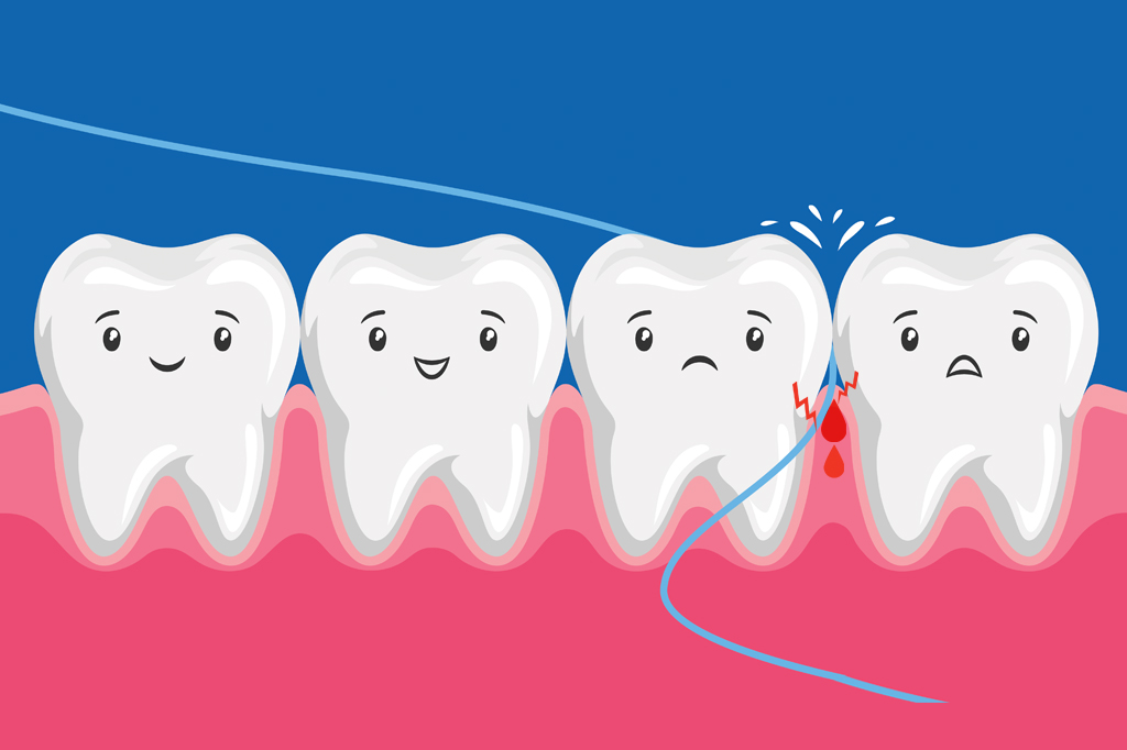 Ilustração cômica de quatro dentes. Os dois da direita sentem um choque, enquanto o fio dental passa entre eles.