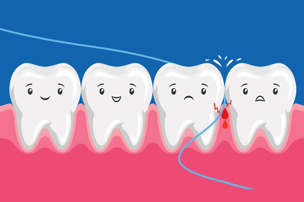 Por que a gengiva sangra às vezes ao passar o fio dental?