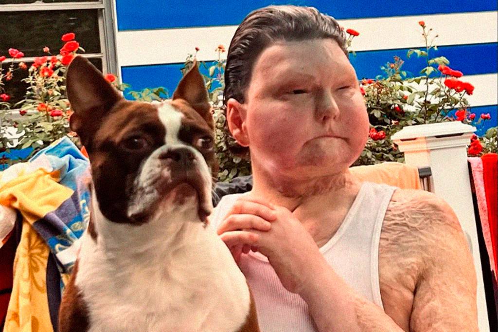 “Eu só queria minha independência de volta”, diz primeiro homem a receber um novo rosto e duas mãos