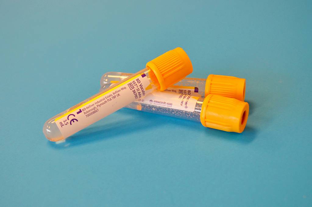Novo exame de sangue pode dizer se o câncer retornou meses antes da tomografia