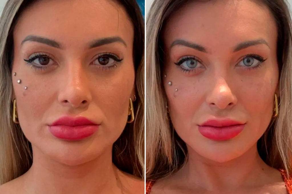 Fotografia do antes e depois da cirurgia da Andressa Urach.