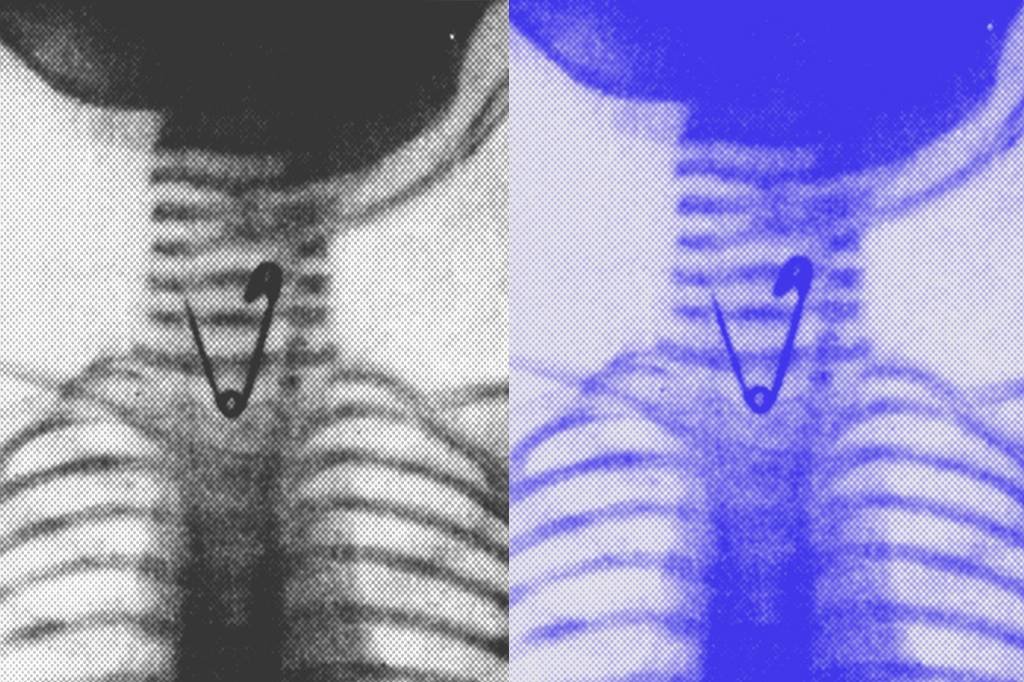De agulhas a projéteis: a tecnologia que encontra metais perdidos no corpo
