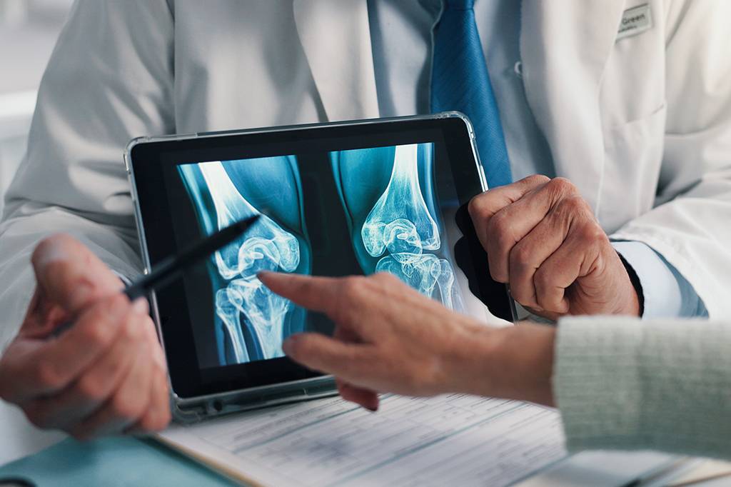 Casos de osteoporose devem disparar até 2050, inclusive no Brasil
