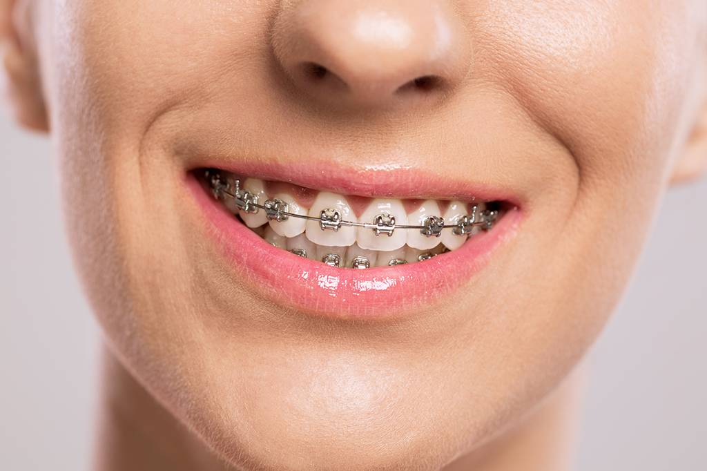 Por que os dentes voltam a entortar após o uso de aparelho ortodôntico