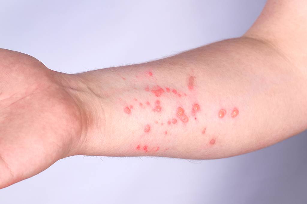 Nova cepa do vírus da Mpox recombinante preocupa OMS e testes mostram que antiviral mais usado não é eficaz