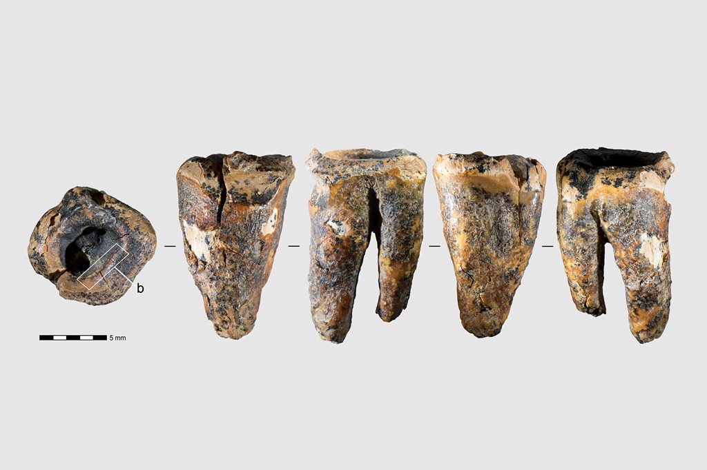 Dentistas pré-históricos? Neandertais podem ter removido cáries com ferramentas de pedra