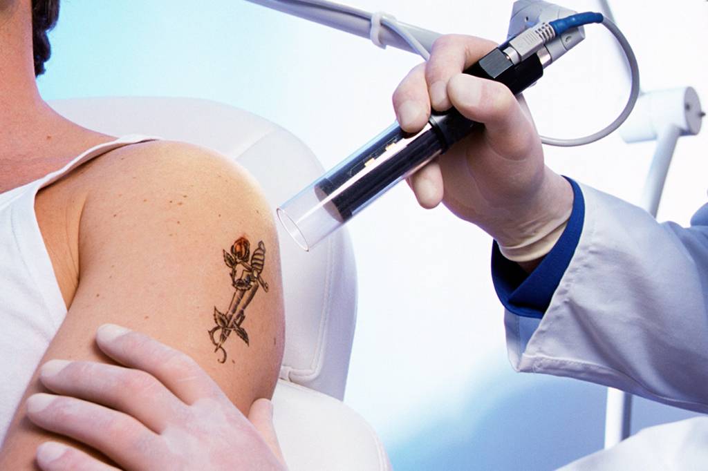 SI_490_Oráculo_Remoção_de_tatuagem