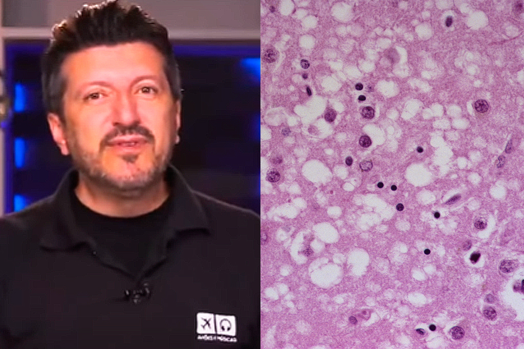 Creutzfeldt-Jakob: entenda a doença enfrentada por Lito Sousa, do canal Aviões e Músicas